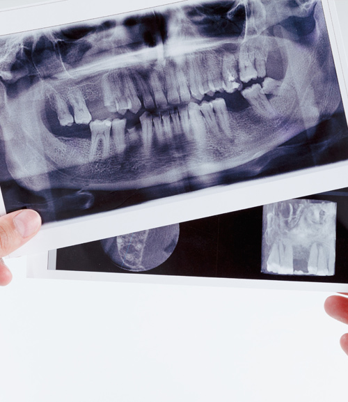 Wisdom Teeth | Kedron Family Dental